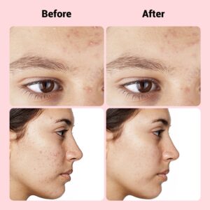 Translucent Microneedle Pimple Patch